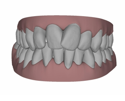 Movilización de dientes con ortodoncia