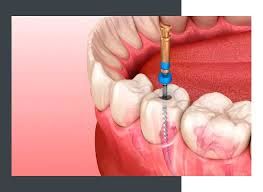 Endodoncia Rotatoria