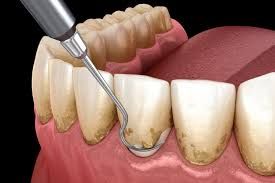 Periodoncia